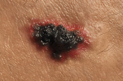 Kombinacija lijekova može zaustaviti širenje uznapredovalog melanoma
