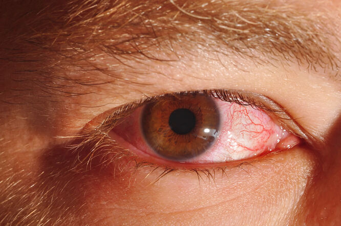 Konjuktivitis I Keratokonjunktivitis Također Mogu Biti Primarni Simptomi Covid 19 Vijesti Cybermed Hr