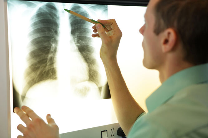 KOPB neovisni čimbenik rizika za rak pluća