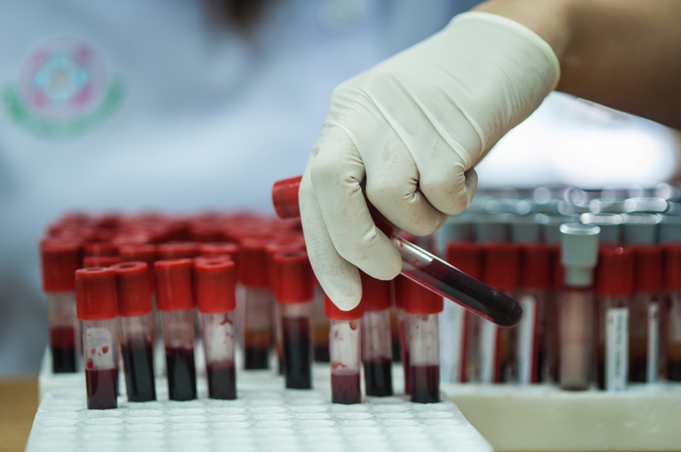 Krvni test može predvidjeti koji će pacijenti s kolorektalnim karcinomom imati koristi od kemoterapije