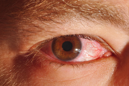 Lijek za akne povećava rizik od razvoja infekcija oka