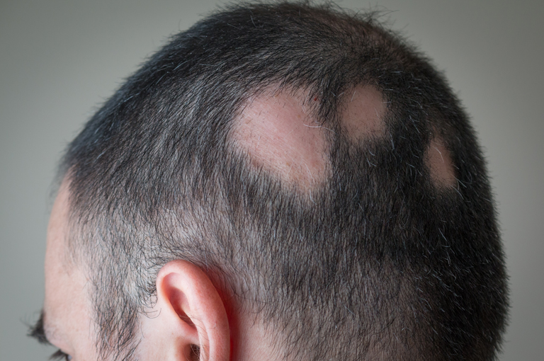 Ljudi s alopecijom imaju veći rizik od upalnog artritisa