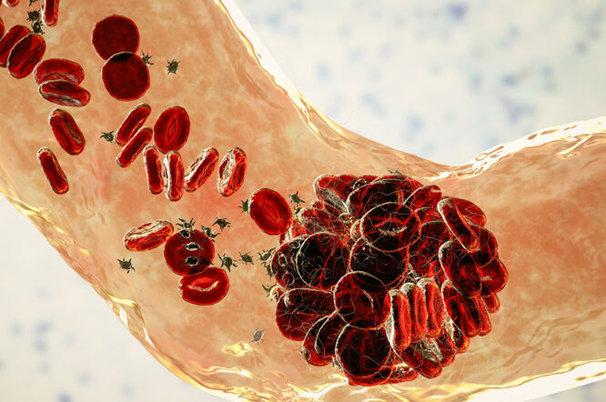 Mehanička trombektomija poboljšava simptome i kvalitetu života bolesnika s plućnom embolijom