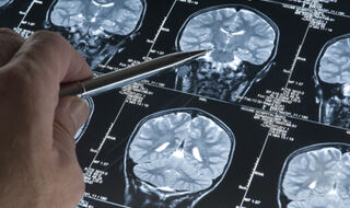 Menopauza povezana sa smanjenim volumenom mozga i povećanim simptomima anksioznosti