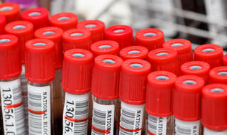 Metaboliti u krvi otkrivaju tko će razviti dijabetes tipa 2 godinama prije dijagnoze