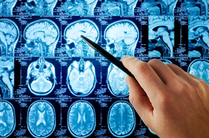 Migrena povezana s nepotpunom mrežom arterija u mozgu