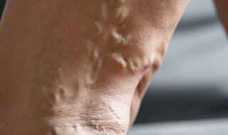 Minimalno invazivno stentiranje učinkovito liječi bolni posttrombotski sindrom