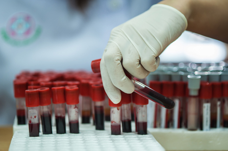 Može li se pomoću krvnog testa rano otkriti rak debelog crijeva?