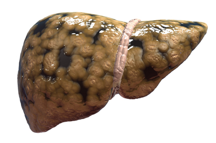 Mršavljenje poboljšava stanje pacijenata s nealkoholnom masnom jetrom