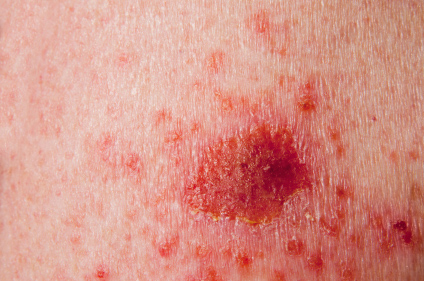 Nemelanomski karcinomi kože povezani s većim rizikom od drugih karcinoma 