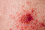 Nemelanomski karcinomi kože povezani s većim rizikom od drugih karcinoma