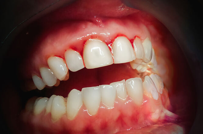 Nezdrave desni i zubi povezani s rizikom od hepatobilijarnog karcinoma