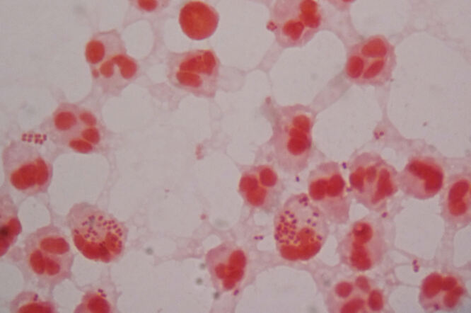 Novi antibiotik obećava u liječenju gonoreje otporne na lijekove