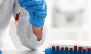 Novi biomarker u krvi prati progresiju ozljede mozga nakon ishemijskog moždanog udara