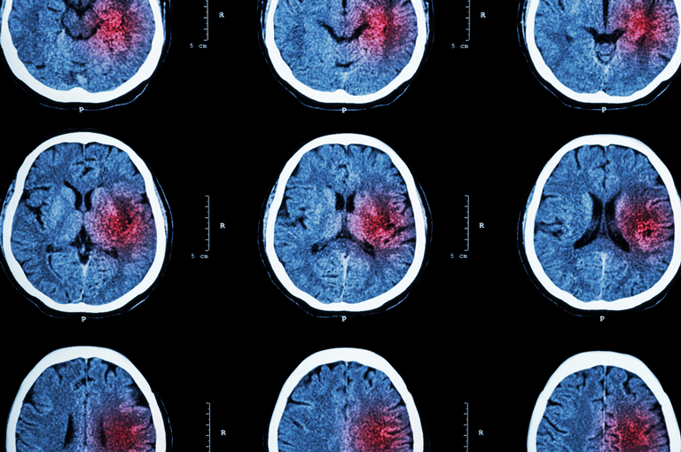 Novi biomaterijal obećava u liječenju aneurizmi mozga