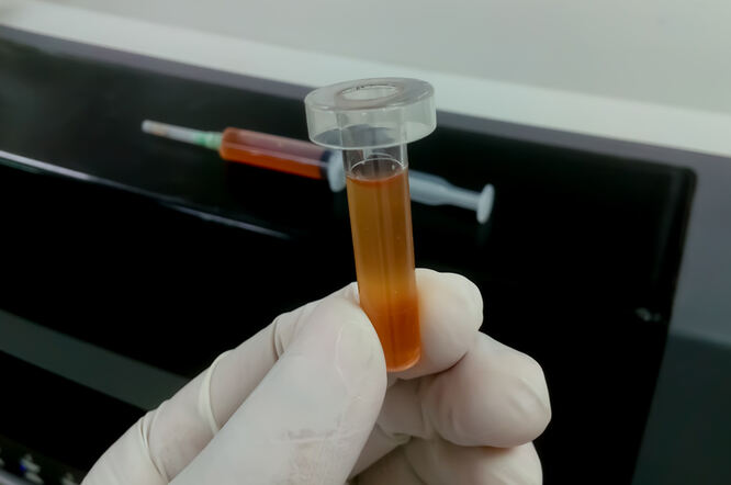 Novi test mogao bi otkriti tumore mozga pomoću cerebrospinalne tekućine