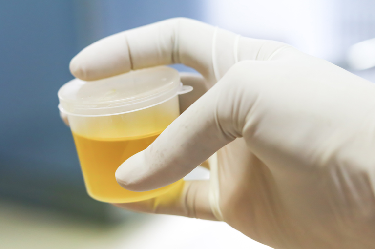 Novi test urina pokazuje agresivnost raka prostate