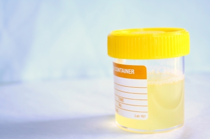 Novi test urina pomaže u ranijem otkrivanju raka prostate