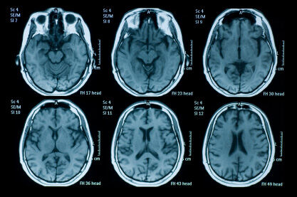 Oštećenje malih krvnih žila u mozgu može povećati rizik od Alzheimerove demencije