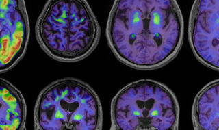 Otkriveno kako se tau spletovi šire iz jedne regije mozga u drugu kod Alzheimerove bolesti