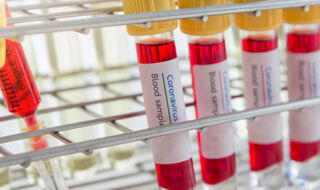 Panel četiri biomarkera poboljšava otkrivanje adenokarcinoma gušterače