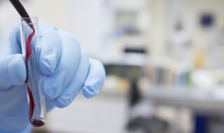 Parkinsonova bolest može proizaći iz potrebe za željezom, a ne iz preopterećenja željezom