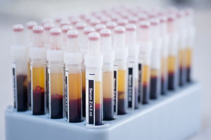 Pomoću krvnog testa mogu se predvidjeti egzacerbacije KOPB-a