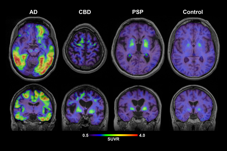 Pomoću tau proteina može se predvidjeti atrofija mozga kod oboljelih od Alzheimerove bolesti