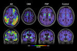 Pomoću tau proteina može se predvidjeti atrofija mozga kod oboljelih od Alzheimerove bolesti