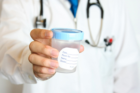Pomoću testa urina može se predvidjeti recidiv raka mokraćnog mjehura
