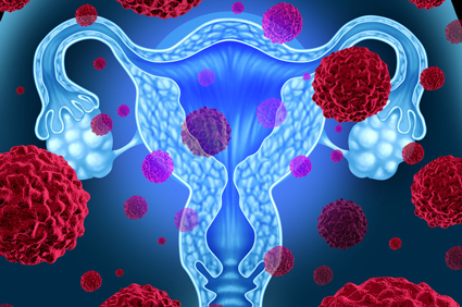 Povećanje učestalosti raka maternice povezano s pretilošću