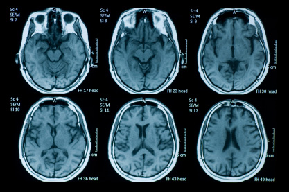 Povišene razine željeza u mozgu mogu biti marker za multiplu sklerozu