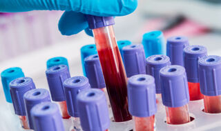 Prediktivna moć promjena C-reaktivnog proteina na temelju ciroze jetre ili koronarne bolesti