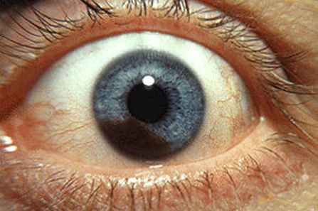 Prekretnica u liječenju melanoma srednje očne ovojnice