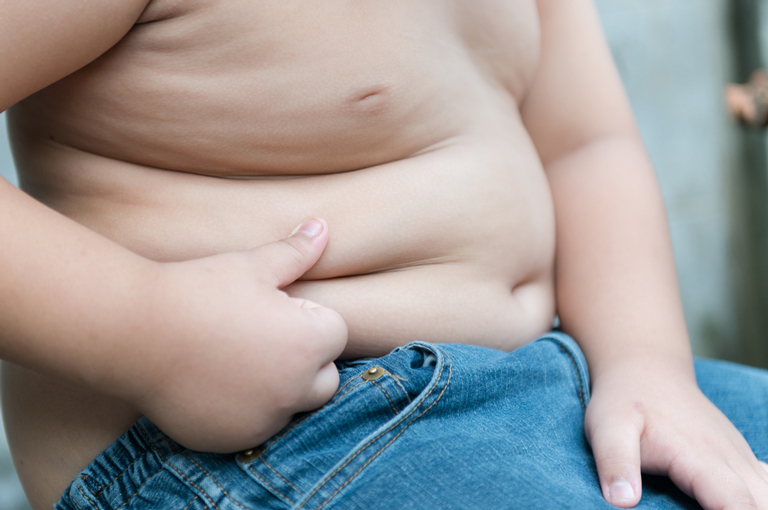 Pretilost u djece povezana s povećanim rizikom od progresije u dijabetes tipa 2