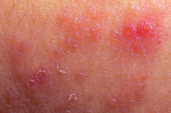 Primjena antibiotika u djetinjstvu povezana s razvojem atopijskog dermatitisa
