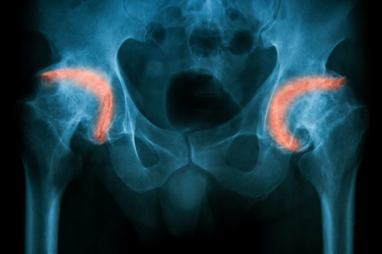 Primjena steroidnih injekcija kod osteoartritisa može pogoršati oštećenje zglobova