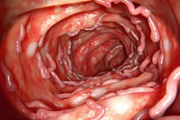 Probiotici i fekalna transplantacija mikrobiote pospješuju stanje oboljelih od ulceroznog kolitisa Probiotici i fekalna transplantacija mikrobiote pospješuju stanje oboljelih od ulceroznog kolitisa