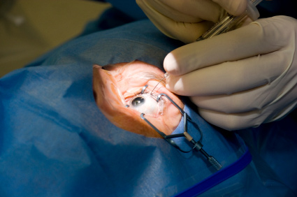Problemi sa vidom česti nakon kirurškog liječenja glaukoma