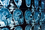 Promjene na mozgu povezuju menopauzu s većim rizikom od Alzheimerove bolesti