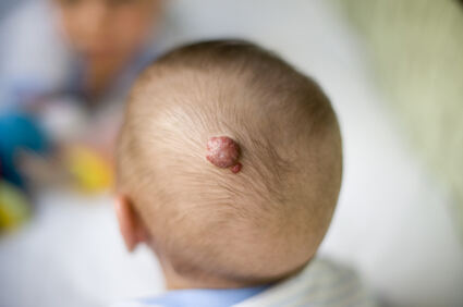Propranolol najučinkovitiji u smanjivanju infantilnog hemangioma