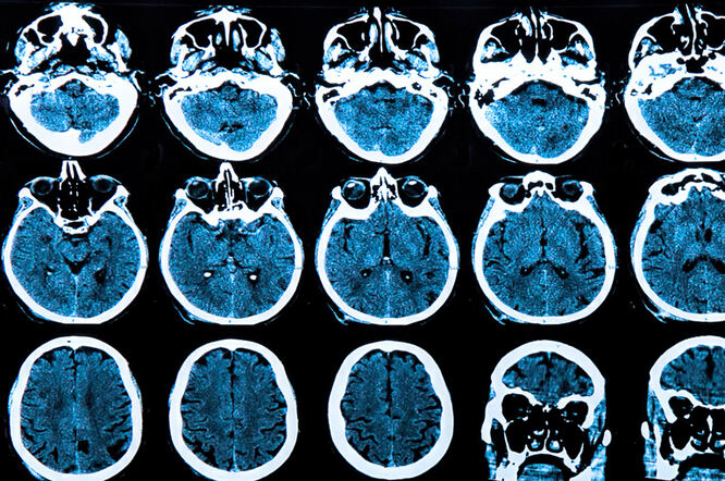 Proteini imunološkog sustava igraju ulogu u ranim stadijima Huntingtonove bolesti
