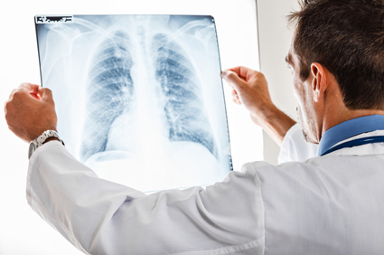 Rak pluća može ostati pritajen više od 20 godina