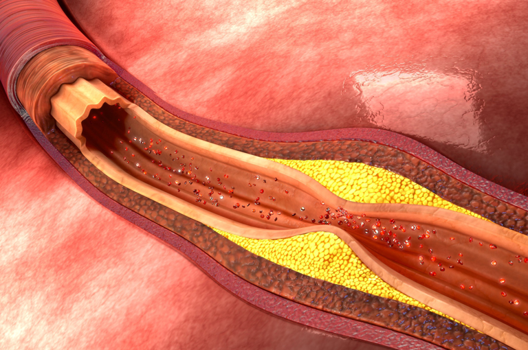 Raznolikost crijevnog mikrobioma utječe na aterosklerozu