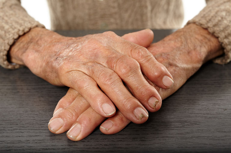 Reumatoidni artritis može povećati rizik od smrti od COVID-19