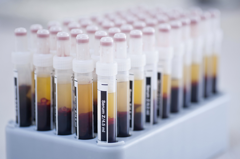 Rutinska krvna pretraga može otkriti tko je najviše izložen riziku od osteoporoze