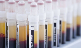 Rutinska krvna pretraga može otkriti tko je najviše izložen riziku od osteoporoze