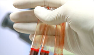 Signali gena u krvi otkrivaju rizik od Parkinsonove bolesti godinama prije dijagnoze