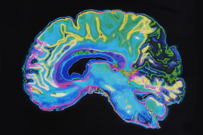 Smanjenje volumena mozga povezano s liječenjem Alzheimerove bolesti može biti uzrokovano uklanjanjem amiloidnog plaka