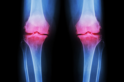Snižavanje tjelesne težine smanjuje degeneraciju hrskavice koljena